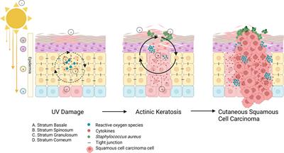 Targeting Staphylococcus aureus dominated skin dysbiosis in actinic keratosis to prevent the onset of cutaneous squamous cell carcinoma: Outlook for future therapies?